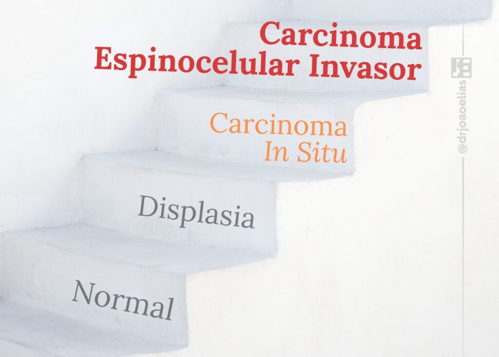 O que é o Carcinoma Espinocelular (CEC) em Cabeça e Pescoço? 7 perguntas cruciais 2 Desenvolvimento do carcinoma espinocelular