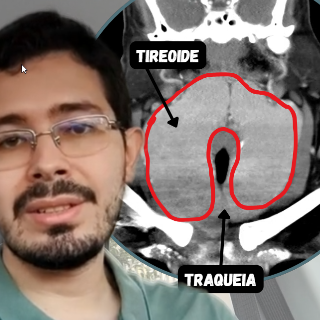 Bócio Gigante de Tireoide: Quando a Cirurgia é a Única Solução para Voltar a Respirar